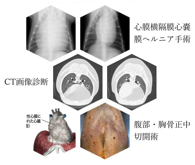 心膜横隔膜心嚢膜ヘルニア治療例
