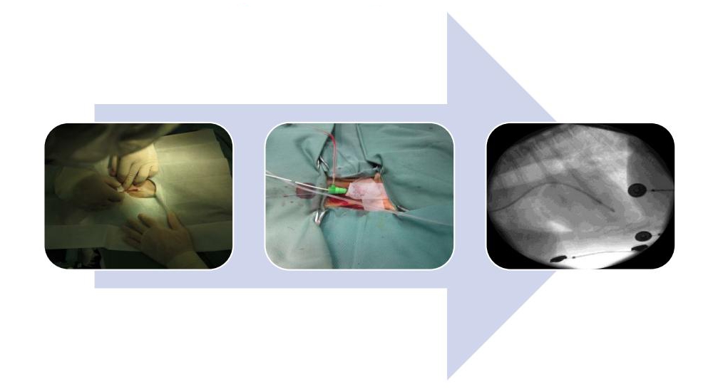 一時ペーシング留置
