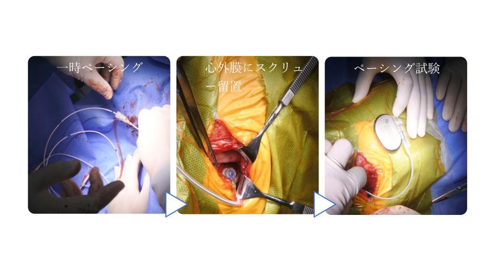 ペースメーカー・リード線心外膜スクリュー留置術